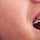 Common Orthodontic Emergencies