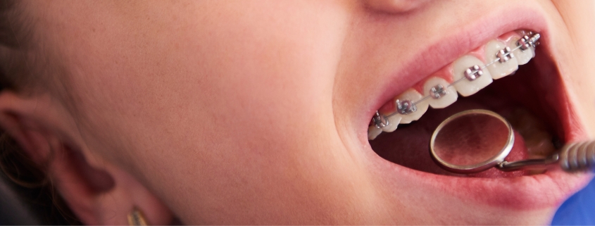 Common Orthodontic Emergencies