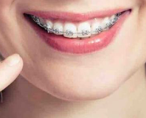 Braces Questions and Answers