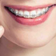 Braces Questions and Answers