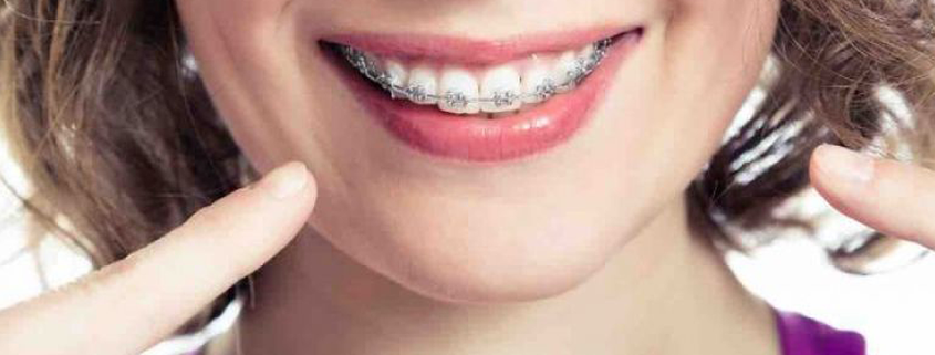 Braces Questions and Answers